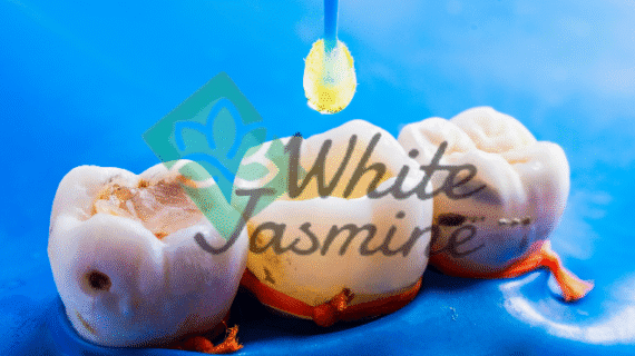 Solusi Gigi Berlubang: Penambalan Gigi di Klinik White Jasmine